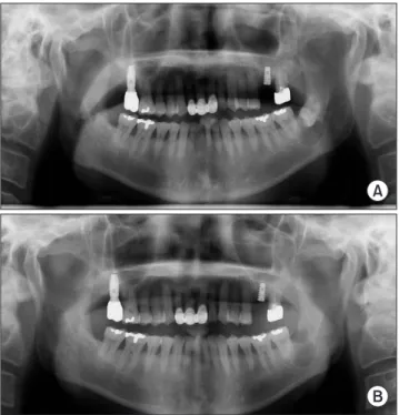 Fig. 1. Case A. Panoramic radiograph before (A) surgery and (B) 4  days after surgery.