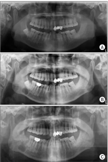 Fig. 4. Case A. Panoramic radiograph 5 months after operation. No  additional bone destruction were observed, but bone formation  was observed.