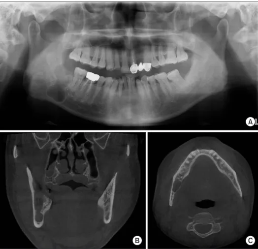 Fig. 6. Case B. Panoramic (A) radiograph,  (B) coronal view and (C) axial view of  cone  beam  computed  tomography  images three weeks after surgery