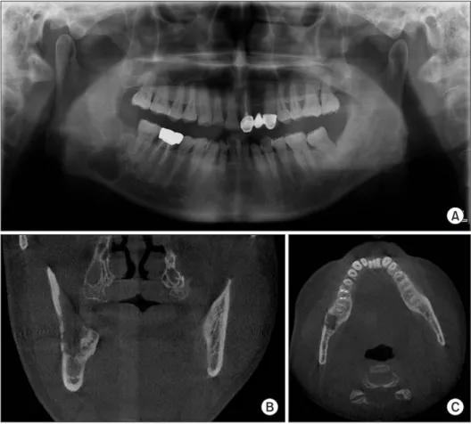 Fig. 8. Case B. Panoramic radiograph 4 months after surgery. 
