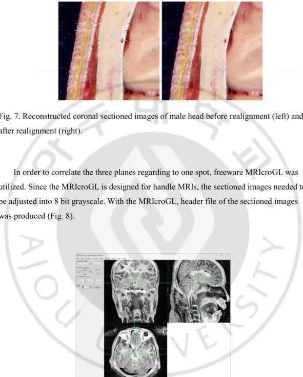 Fig. 7. Reconstructed coronal sectioned images of male head before realignment (left) and  after realignment (right)