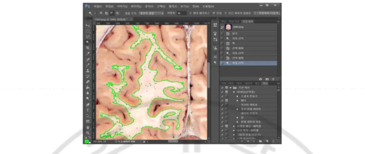 Fig. 15. Segmented area of white matter is peeled by drawing internal green line inside the  segmentation zone and selected again