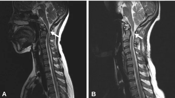 Fig. 1. The sagittal T2 weighted cervical spine MRI scan at 4 days before spinal fusion (A), and at 6 weeks after spinal fusion (B) showed high signal intensity lesion at the level of C1-2 (arrow), but no significant interval change.