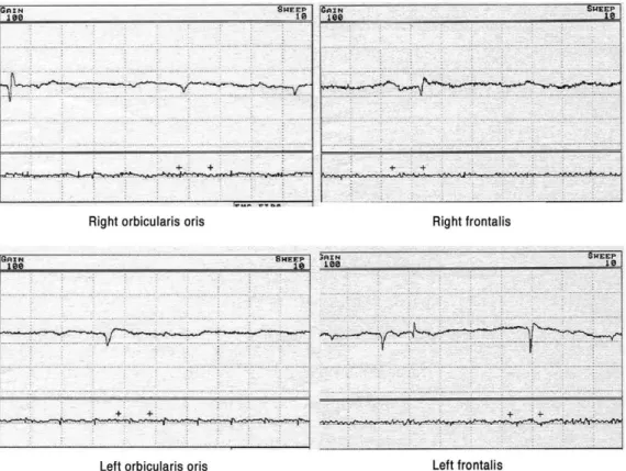 Fig. 2. Electrophysiologic studies showed mild denervation potentials in bilateral orbicularis oris and frontalis muscles in facial EMGs