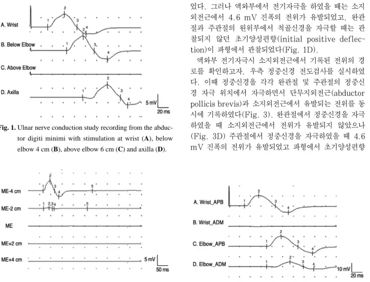Fig. 2. Ulnar nerve conduction study recording from the abduc- abduc-tor digiti minimi, inching from below to above the elbow in 2-cm increments