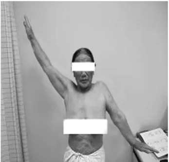 Fig. 2. Herpes zoster skin lesion with bullae formation was well localized on the C7 dermatome of the left upper trunk.
