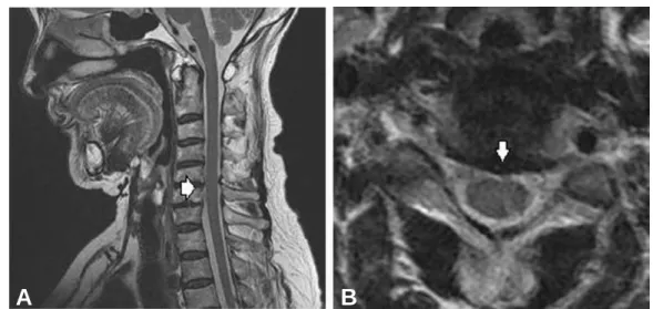 Fig. 3. Cervical spine MRI shows mild bulging (arrow) of intervertebral disc at C5-6 of lateral view (A) and sagittal view (B).