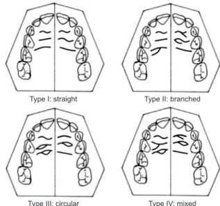 Fig. 1. Classification of the types of palatal rugae pattern based on  the methods developed by the article of Surekha et al