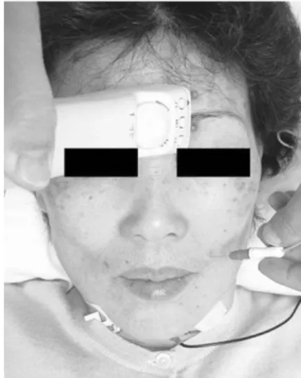 Fig. 1. Recording of synkinetic spread response with needle electrode at left orbicularis oris during stimulation of supraorbital notch in a patient with left facial palsy.