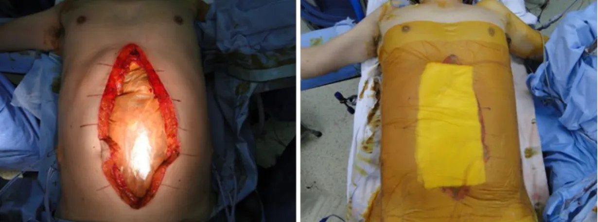Fig.  3.  We  first  wrapped  intra-abdominal  organs  in  one  sterile  vinyl  to  perform  temporary abdominal closure and then attached two antimicrobial incise drapes (3M TM Ioban TM ) to the abdominal wall after covering the wound using sterile pads