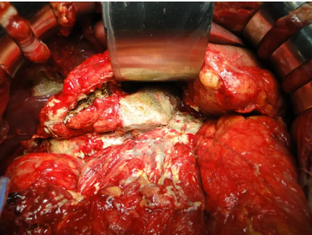 Fig.  5.  We  performed  abdominal  wall  closure  after  checking  for  further  leakage  from  the pancreatic stump in a third operation
