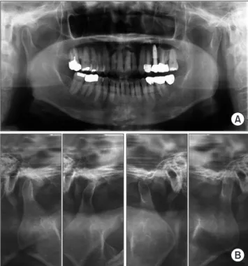 Fig. 1. Right preauricular swelling in the patient (arrowheads).
