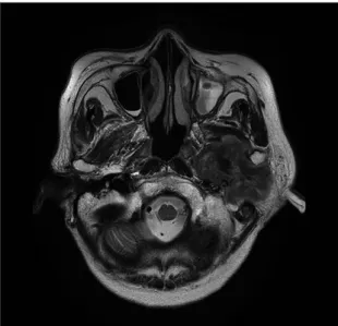 Fig. 2. Transcranial view of the patient also showing left condyle  deviation from its original position, which is consistent with the  finding in Fig