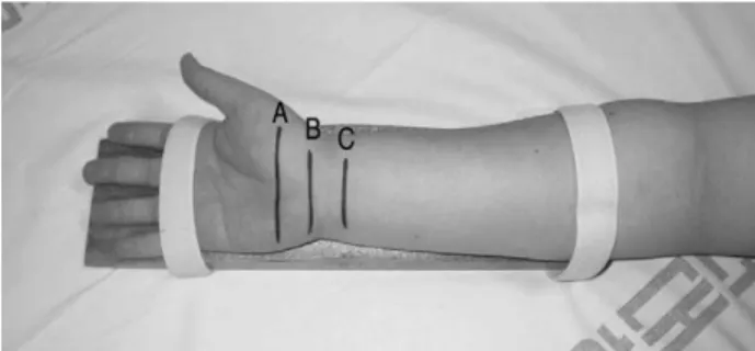 Fig. 1. The marking of levels in forearm and fixation of wrist by wedge support. Distal (A), middle (B), and proximal (C) levels shown correspond to the hook of hamate, pisiform, and radio-ulnar joint level, respectively.