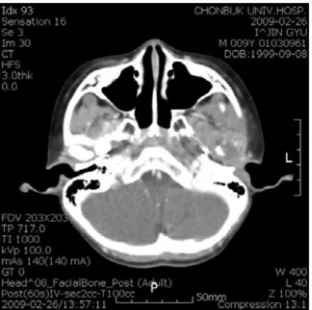 Fig.  2a.  Coronal  view  of  left  mandibular  condyle  by  cone  beam  CT. 