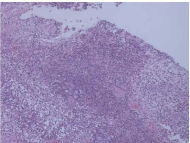 Fig. 5b. Microscopic  view  shows  infiltration  consisting  of  multiple  macrohages,  lymphocytes  with  embedded  giant  cells(  x40,  H&amp;  E  stain).