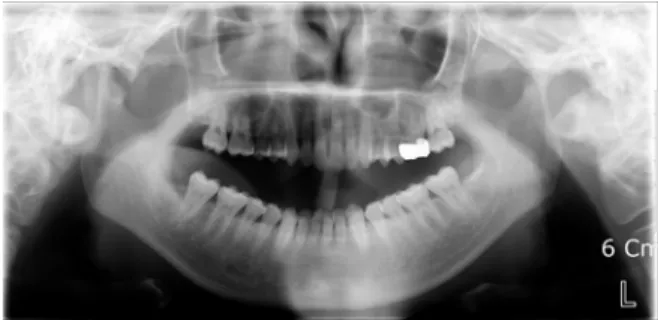 Fig.  1.  Panoramic  view  of  first  examination  Severly  flattening  and  irregularity  of  both  condyle  of  mandible.