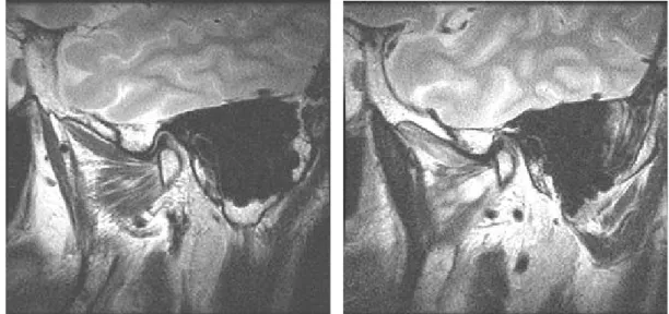 Fig. 6. On T2 weighted image of MRI, (a) normal right lateral pterygoid muscle, (b) left lateral pterygoid muscle with high signal and left temporal muscle with low signal