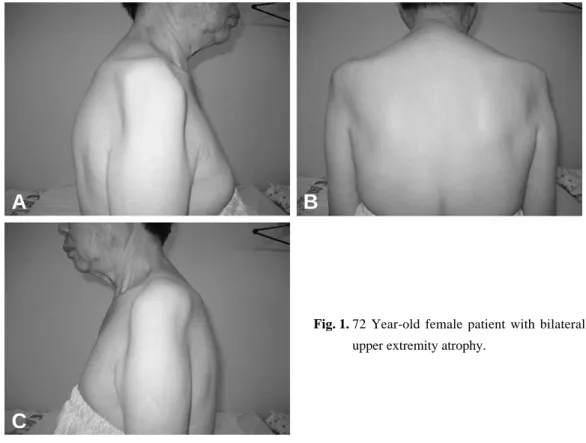 Fig. 1. 72 Year-old female patient with bilateral upper extremity atrophy.