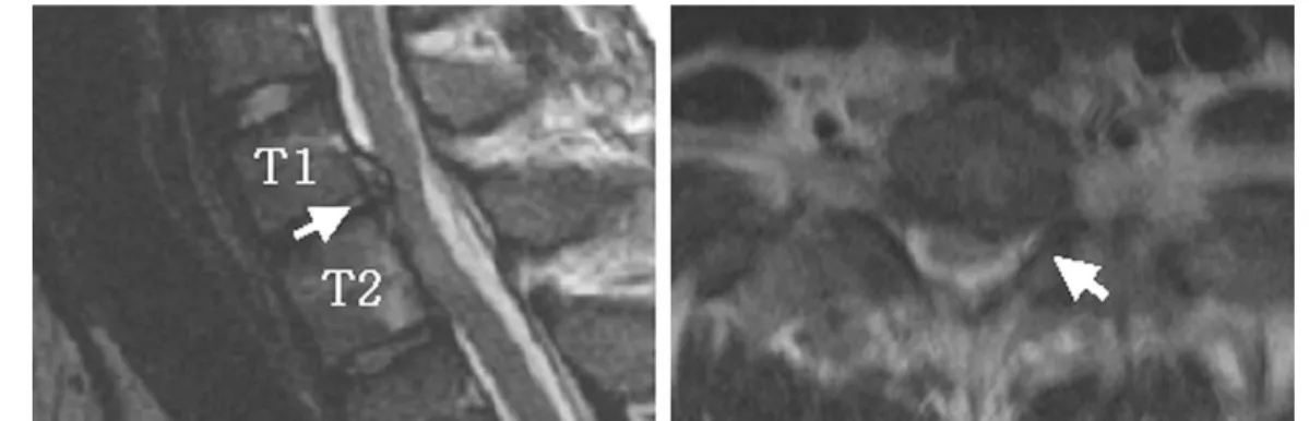 Fig. 1. Thoracic spine MRI shows central to left herniation of intervertebral disc at T1-2 level.