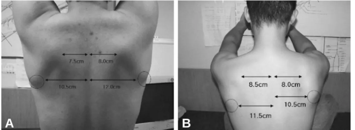 Table 1. Results of Nerve Conduction Study on Both Serratus Anterior Muscles 