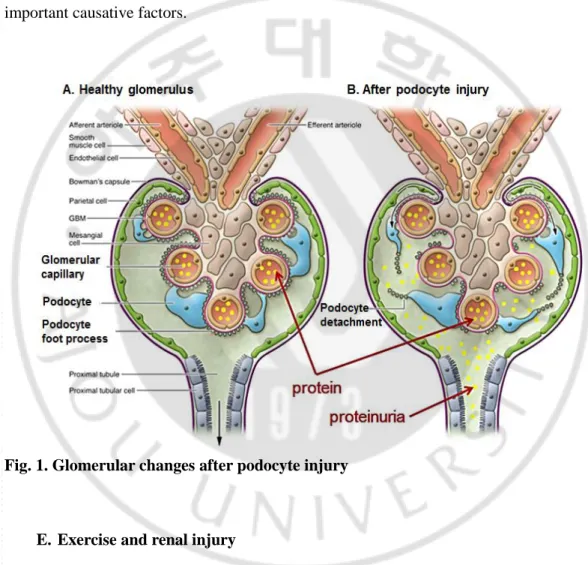 Fig. 1. Glomerular changes after podocyte injury    