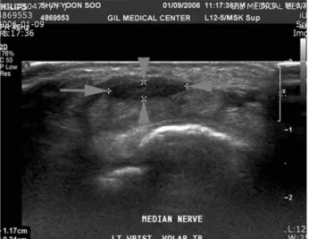 Fig. 5.*Between tailed arrow, t = transverse diameter, 11.7 mm Fig. 5.*Between arrow head, l = vertical diameter, 2.4 mm Fig