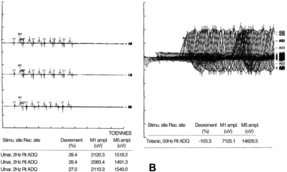 Fig. 1. (A) Repetitve nerve stimulation of abductor digiti quinti muscle at 2, 3, 5 Hz shows decremental responses of CMAP ampli- ampli-tude more than 20 percent at 5th stimulation compared with first one