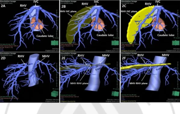 Fig. 2. The methods to define the right and ventral margins are shown. A: IVC and  RHV can be identified after hiding the hepatic parenchyma other than the caudate  lobe