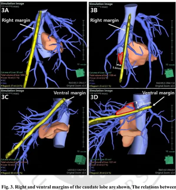 Fig. 3. Right and ventral margins of the caudate lobe are shown. The relations between  the caudate lobe and right hepatic vein and inferior vena cava (RHV-IVC) plane and  the middle and right hepatic veins (MHV-RHV) plane is shown in Synapse 3D images
