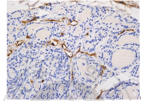 Fig. 1.D2-40 Immunostain for intratumoral area. D2-40 immunostain showed positive for 