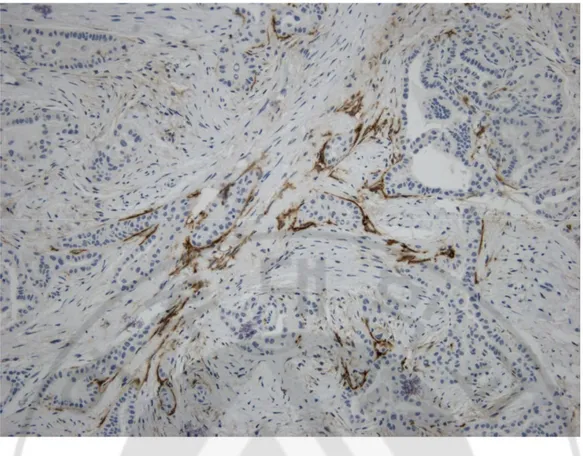 Fig.  2.Immunostain  for  peritumoral  area.D2-40  immunostain  showed  positive  for 