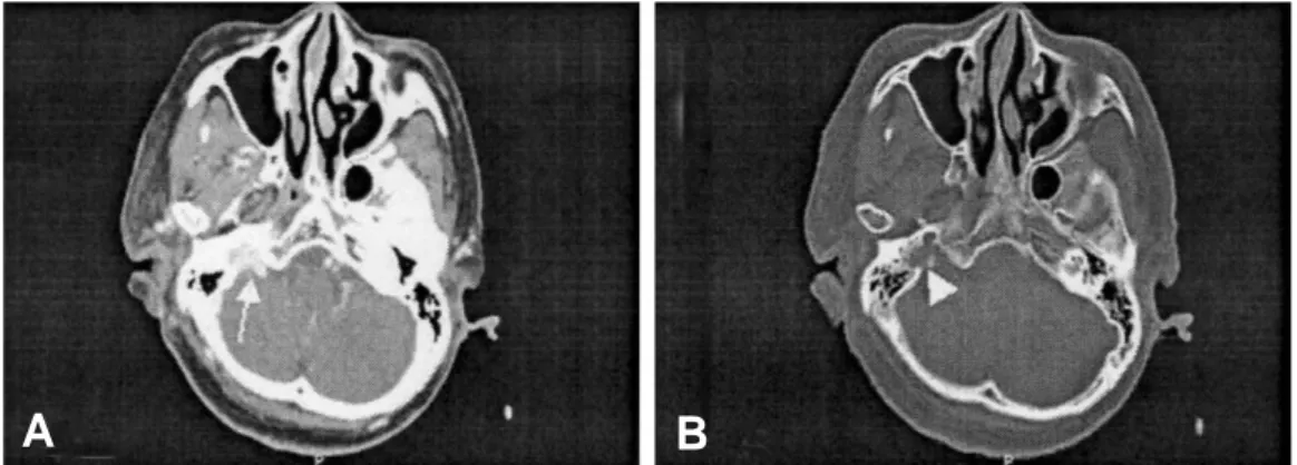 Fig. 1. Brain CT. enhanced axial image (A) and bone setting image (B) Arrow in (A) indicates the mass with hypervascularity at the right jugular foramen and arrow in (B) indicates the widening with bony destruction at the right jugular foramen.