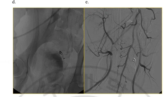 Fig.  1.  Embolization  procedure.  (a)  Pelvic  angiography  shows  contrast  blush  of  the 