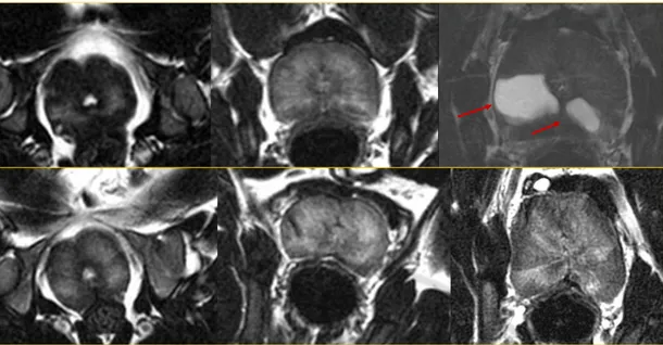 Fig.  3.  T2  weighted  MR  images  of  dogs  with  embolization  (upper  row)  and  without  embolization (bottom row) in group B