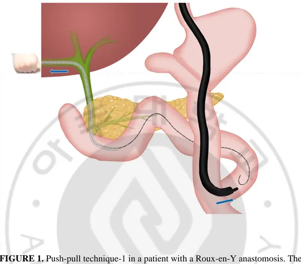 FIGURE 1. Push-pull technique-1 in a patient with a Roux-en-Y anastomosis. The 