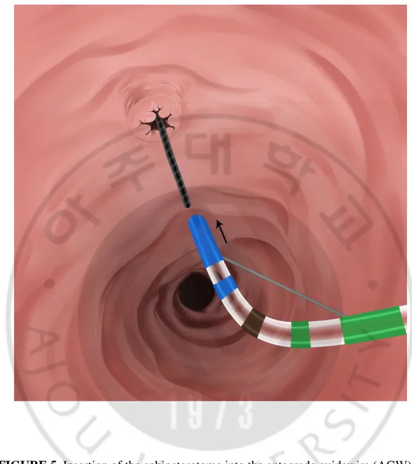 FIGURE 5. Insertion of the sphincterotome into the antegrade guidewire (AGW) 