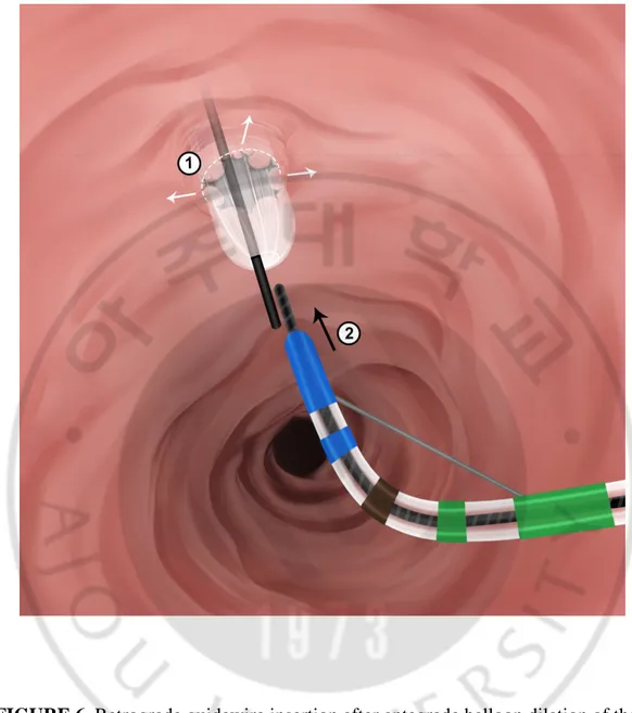 FIGURE 6. Retrograde guidewire insertion after antegrade balloon dilation of the 