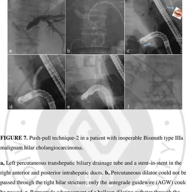 FIGURE 7. Push-pull technique-2 in a patient with inoperable Bismuth type IIIa 