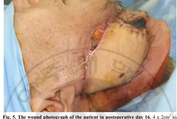 Fig. 5. The wound photograph of the patient in postoperative day 16. 4 x 2cm 2  sized 