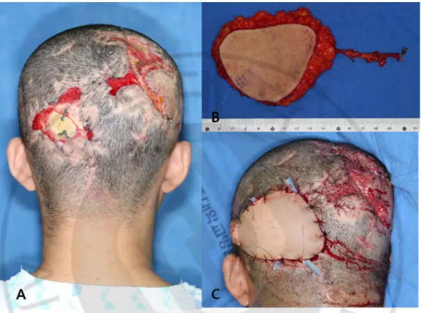 Fig. 6. Preoperative, intraopeartive and postoperative views of case # 2 patient. Multiple 