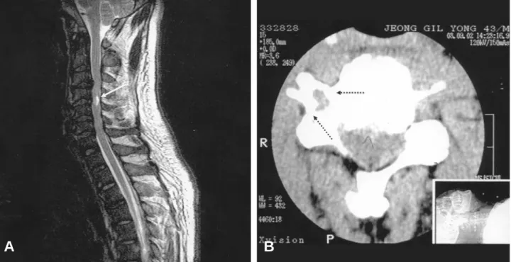 Fig. 1. Cervical MRI (A) and CT(B) finding in cse 1. Arrow in (A) indicate the cervical cord signal shange at C4 level and broken arrow in (B) indicate the fracture of C4 transverse process.
