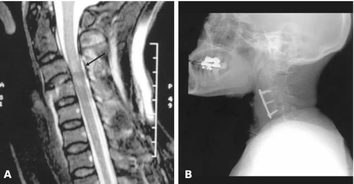 Fig. 3. Nerve conduction study of phrenic nerve4 in case 1, right (A) and left (B). (stimulation : posterior border of sternocleidomas- sternocleidomas-toid muscle, recording: active - xyphoid process, reference - chest wall)