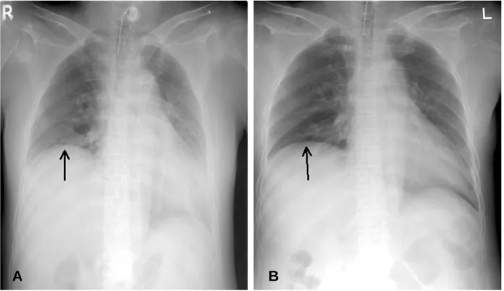 Fig. 5. Right hemidiaphragm elevation at the time of admission (A) and 2 months later (B) in case 2 which Showed