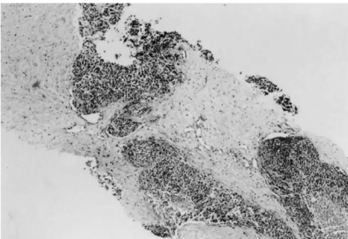 Fig. 1. Nested and trabeculated tumor cell clusters in needle biopsied tissue from neck node