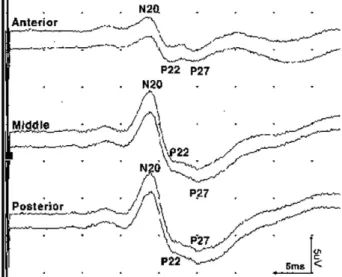 Fig. 3. Waveform identification of each peak of median nerve somatosensory evoked potentials