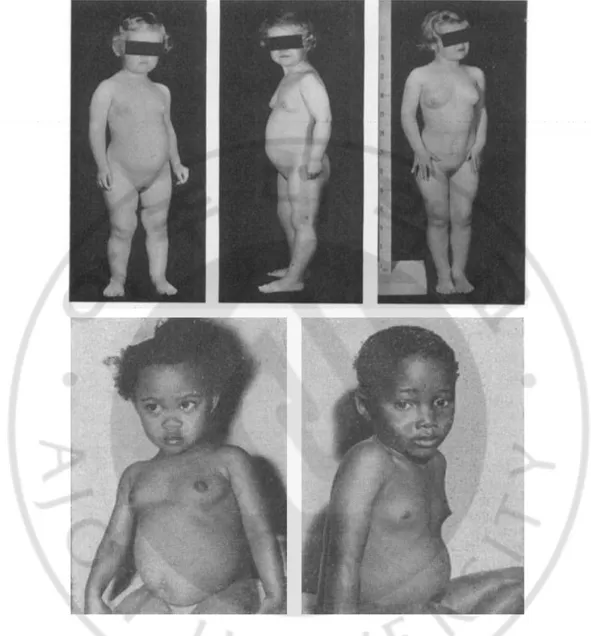 Figure  1.  Secondary  characteristics  shown  at  an  early  age  in  patients  with  precocious puberty (Bruk et al., 1960; McGeorge and Connor, 1961)