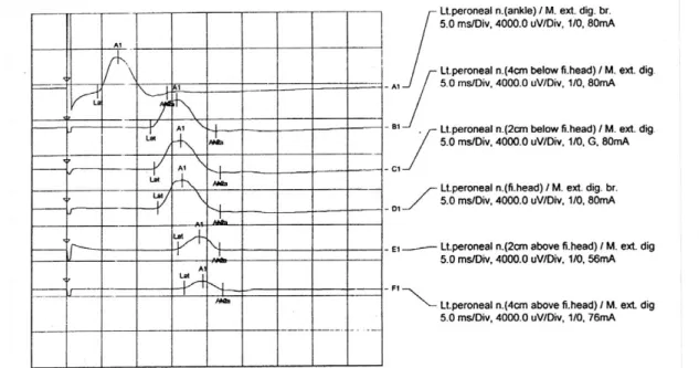 Fig. 1. Conduction block across the fibular head. The common peroneal nerve is stimulated, and the extensor digitorum brevis is recorded