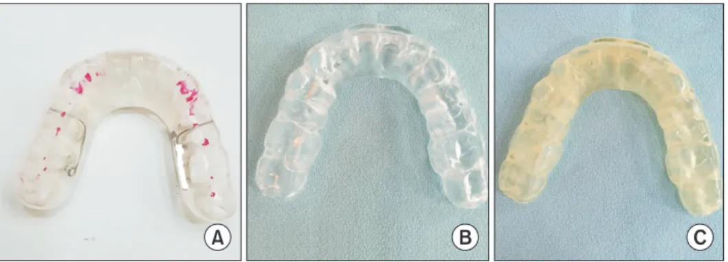 Fig. 2. Comparison of three kinds of  stabilization splints. (A) Conventional  additive method splint