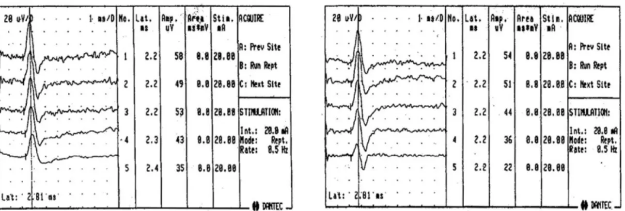Fig. 2. High and low frequency filter effects on sensory nerve action potentials (SNAPs)